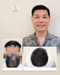 نتائج زراعة الشعر قبل وبعد في عيادة Namninforv، استعادة خط الشعر الممتلئ