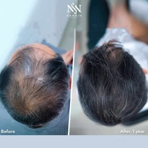Haartransplantation Ergebnisse bei Namninforv Clinic – volleres Haar nach 1 Jahr
