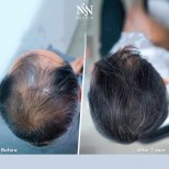 Haartransplantation Ergebnisse bei Namninforv Clinic – volleres Haar nach 1 Jahr
