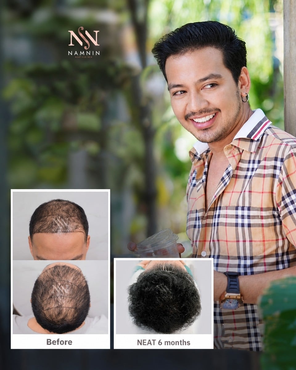 Resultados de trasplante capilar antes y después en Namninforv Clinic, cabello más denso tras 6 meses