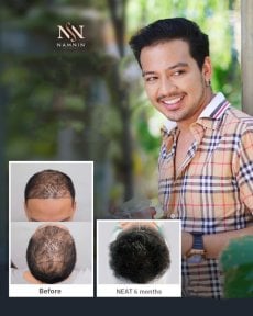 Vorher-nachher-Ergebnis der Haartransplantation bei Namninforv Clinic, volleres Haar nach 6 Monaten