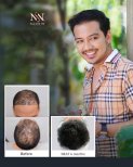 Vorher-nachher-Ergebnis der Haartransplantation bei Namninforv Clinic, volleres Haar nach 6 Monaten