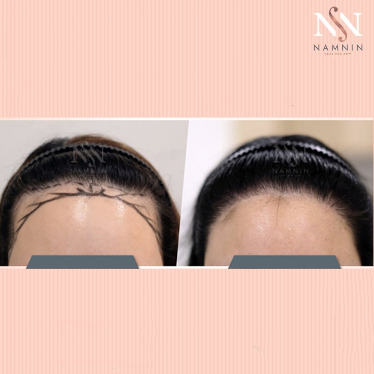 نتائج زراعة الشعر للنساء قبل وبعد في عيادة Namninforv، خط شعر محسّن