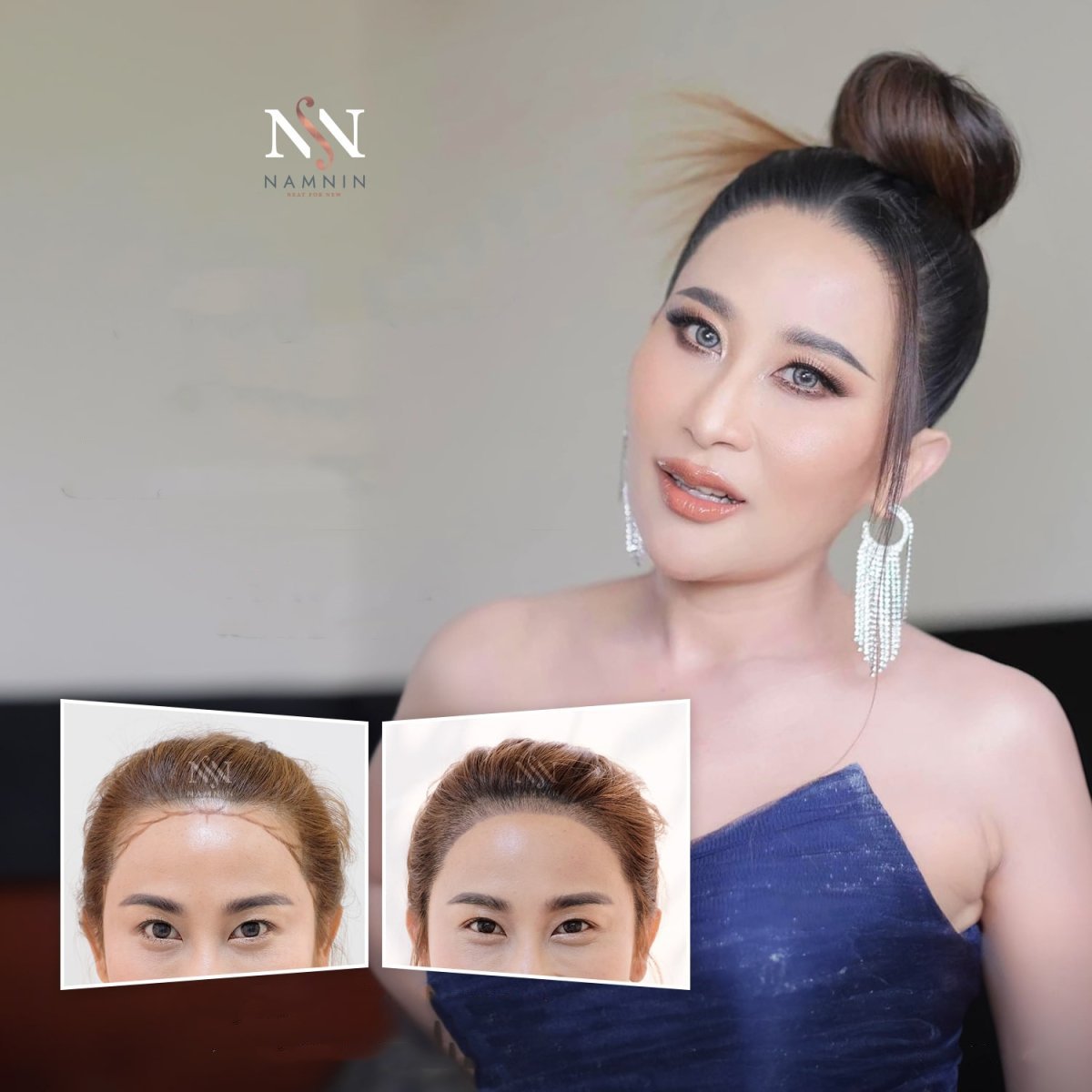 نتائج زراعة الشعر للنساء قبل وبعد في عيادة Namninforv، خط شعر أكثر كثافة