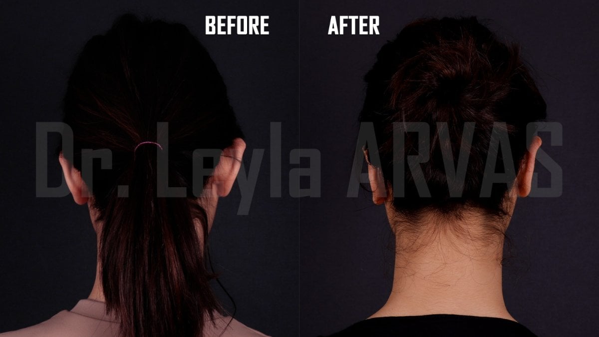 Resultados de otoplastia antes y después en Quartz Hospital, mejora de forma y simetría