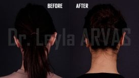 صور قبل وبعد جراحة الأذن (انظر. تجميل الأذن) للدكتور 