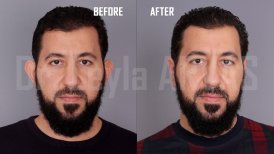 صور قبل وبعد جراحة الأذن (انظر. تجميل الأذن) للدكتور 