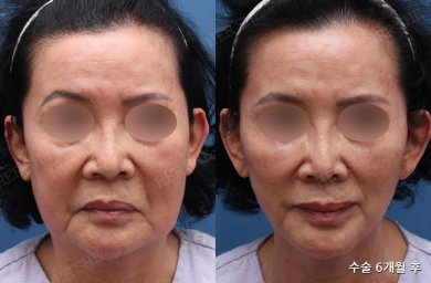 HERSHE Plastic Surgery Korea