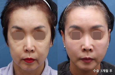 HERSHE Plastic Surgery Korea