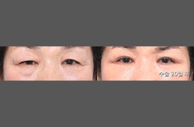 HERSHE Plastic Surgery Korea