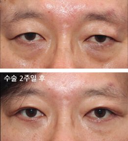 HERSHE Plastic Surgery Korea