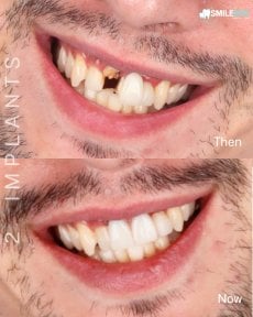 Before and after dental implants at SmileBox Clinic – improved smile with 2 implants result
