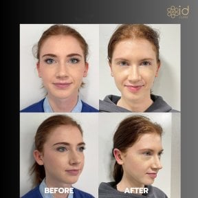 Before and after otoplasty results at ID Clinic Bangkok, ear reshaping for natural look