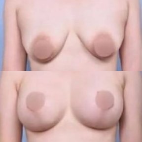 Vorher-nachher-Ergebnis Brustverkleinerung bei VG Plastic Surgery, verbesserte Kontur