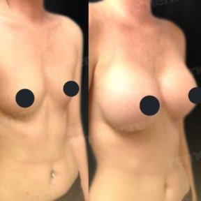 Before and after breast augmentation results at Memorial Şişli Hospital, enhanced breast volume