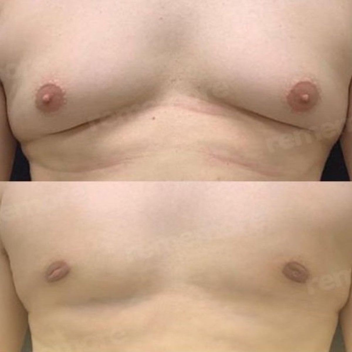 Resultados antes y después de liposucción Vaser en pecho masculino en Memorial Şişli Hospital