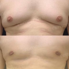 Before and after Vaser liposuction results for male chest at Memorial Şişli Hospital