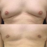 Before and after Vaser liposuction results for male chest at Memorial Şişli Hospital