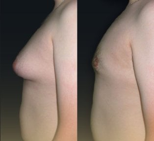 Before and after Vaser liposuction for gynecomastia at Memorial Şişli Hospital, chest contour result