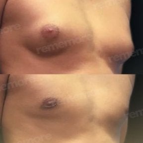 Before and after Vaser liposuction results on male chest at Memorial Şişli Hospital