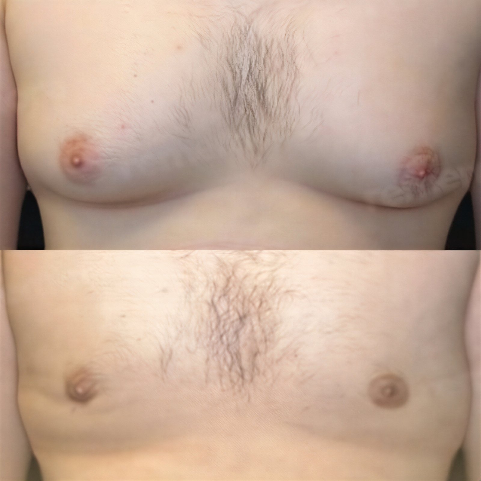Antes y después de liposucción Vaser para ginecomastia en Memorial Şişli Hospital, resultado de contorno de pecho
