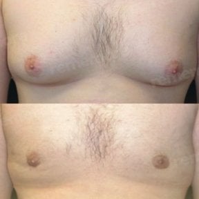 Before and after Vaser liposuction for gynecomastia at Memorial Şişli Hospital, chest contour result