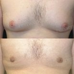 Before and after Vaser liposuction for gynecomastia at Memorial Şişli Hospital, chest contour result