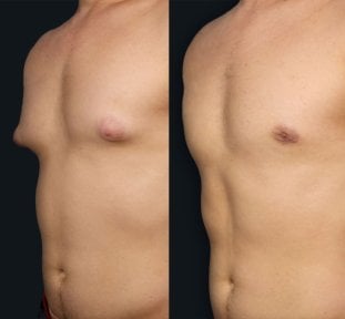 Before and after Vaser liposuction results for male chest at Memorial Şişli Hospital
