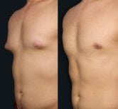 Before and after Vaser liposuction results for male chest at Memorial Şişli Hospital