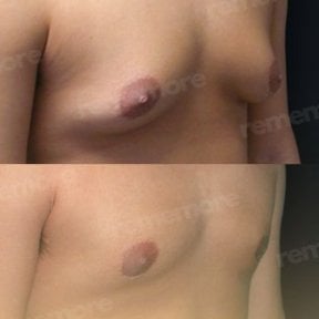Before and after gynecomastia surgery results at Memorial Şişli Hospital, chest contour improved