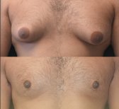 Before and after Vaser liposuction for gynecomastia at Memorial Şişli Hospital, chest contour result