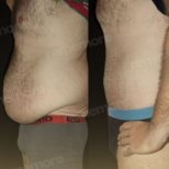 Before and after Vaser liposuction results at Memorial Şişli Hospital, improved abdominal contour