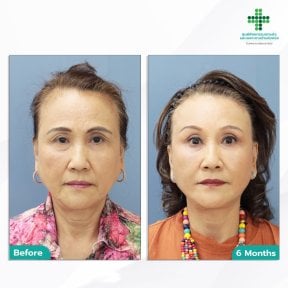 Facelift before and after results at Intrarat Hospital – visible facial rejuvenation at 6 months
