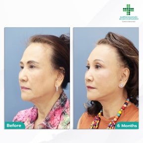 Facelift before and after results at Intrarat Hospital – visible facial rejuvenation after 6 months