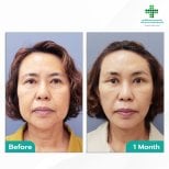 Facelift before and after results at Intrarat Hospital, visible facial rejuvenation after 1 month