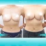 Resultados antes y después de aumento de senos en Wansiri Hospital, elevación y simetría visibles