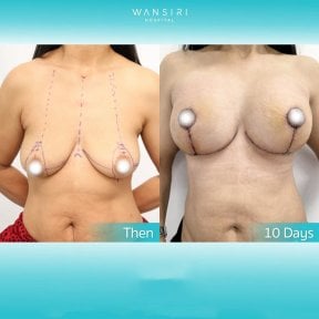 Antes y después de aumento de senos en Wansiri Hospital, elevación y mejora del contorno