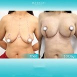 Antes y después de aumento de senos en Wansiri Hospital, elevación y mejora del contorno