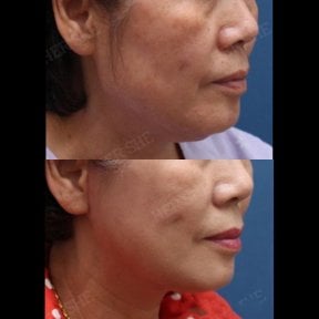 Resultados de lifting facial antes y después en HERSHE Plastic Surgery Korea, rejuvenecimiento