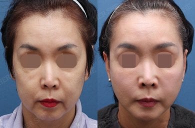 Resultados de lifting facial antes y después en HERSHE Plastic Surgery Korea, rejuvenecimiento