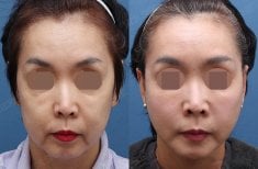 Resultados de lifting facial antes y después en HERSHE Plastic Surgery Korea, rejuvenecimiento