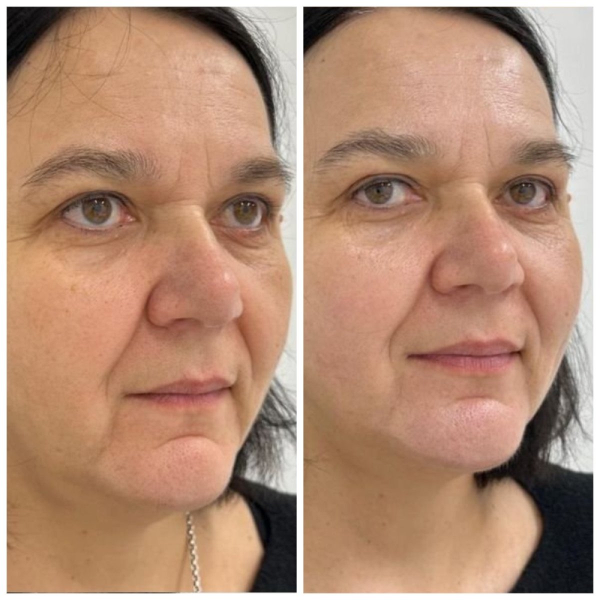 Resultados de minilifting facial antes y después en Altos Clinic – rejuvenecimiento visible