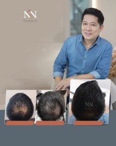 DHI-Haartransplantation Vorher-Nachher-Ergebnisse bei Namninforv Clinic – mehr Haardichte