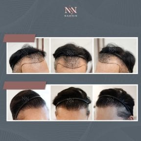 Vorher-nachher-Ergebnisse DHI-Haartransplantation bei Namninforv Clinic, Haaransatz erneuert