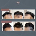 Vorher-nachher-Ergebnisse DHI-Haartransplantation bei Namninforv Clinic, Haaransatz erneuert