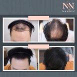 Vorher-nachher-Ergebnisse der DHI-Haartransplantation in der Namninforv Clinic, mehr Dichte