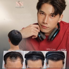 FUE-Haartransplantation Vorher-Nachher-Ergebnisse bei Namninforv Clinic, Haaransatz nach 1 Jahr