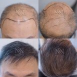 Vorher-nachher-Ergebnisse FUE-Haartransplantation bei Namninforv Clinic, mehr Haardichte