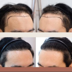 Vorher-nachher-Ergebnisse FUE-Haartransplantation bei Namninforv Clinic, Haaransatz wiederhergestellt