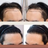 Vorher-nachher-Ergebnisse FUE-Haartransplantation bei Namninforv Clinic, Haaransatz wiederhergestellt